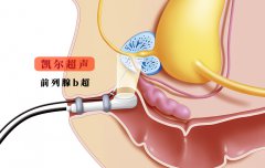 【前列腺b超】男性前列腺健康的B超檢查是這么回